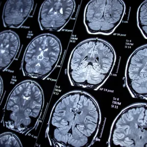 brain scan