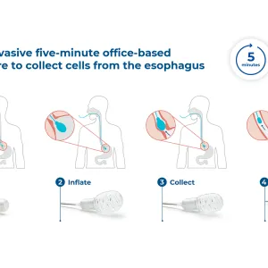 EsoGuard™ Infographic