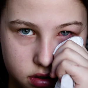 Image of pink eye