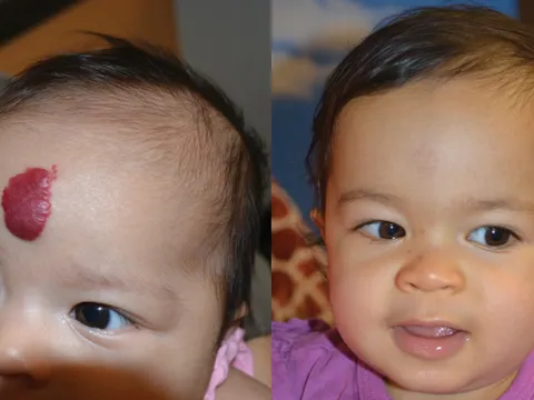 Before and After child with hemangioma