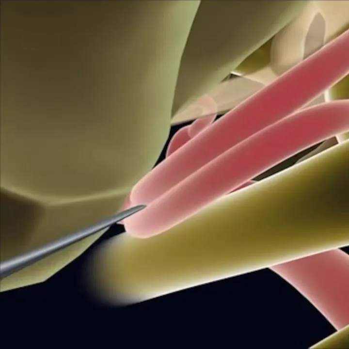 Endoscopic Microvascular Decompression - Minimally Invasive Brain Surgery