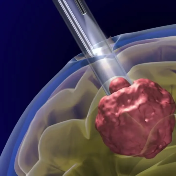 Brain Port Surgery - Minimally Invasive Brain Surgery