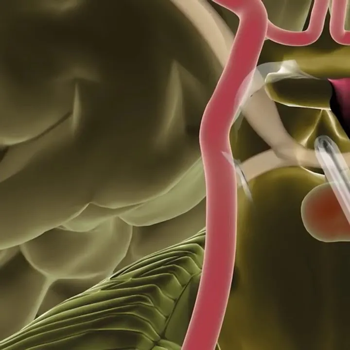 Endoscopic Endonasal Skull Base Surgery - Minimally Invasive Brain Surgery