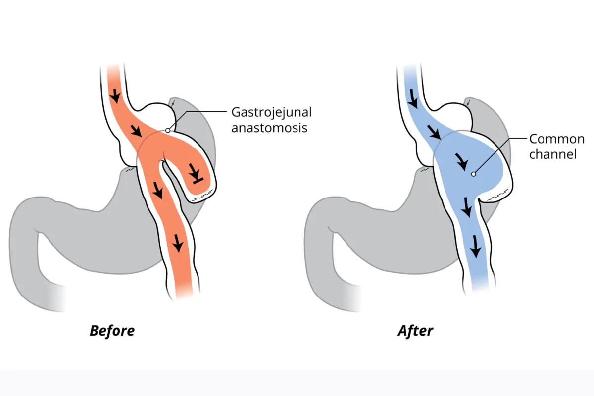 Candy Cane procedure diagram