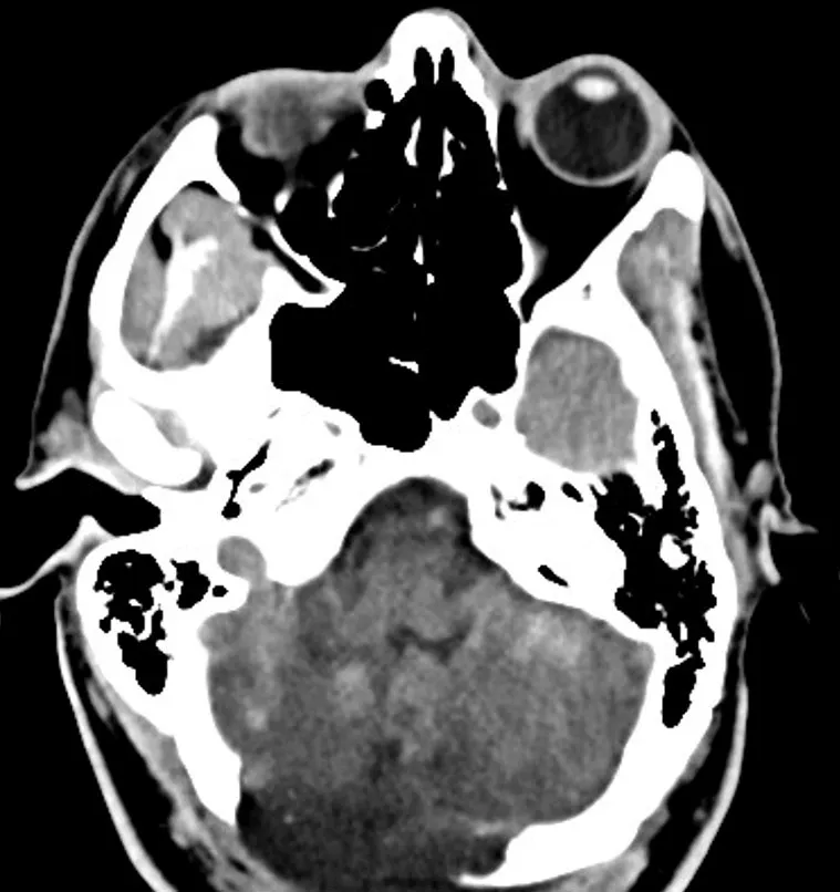 Follow-up CT with improvement of cerebellar edema