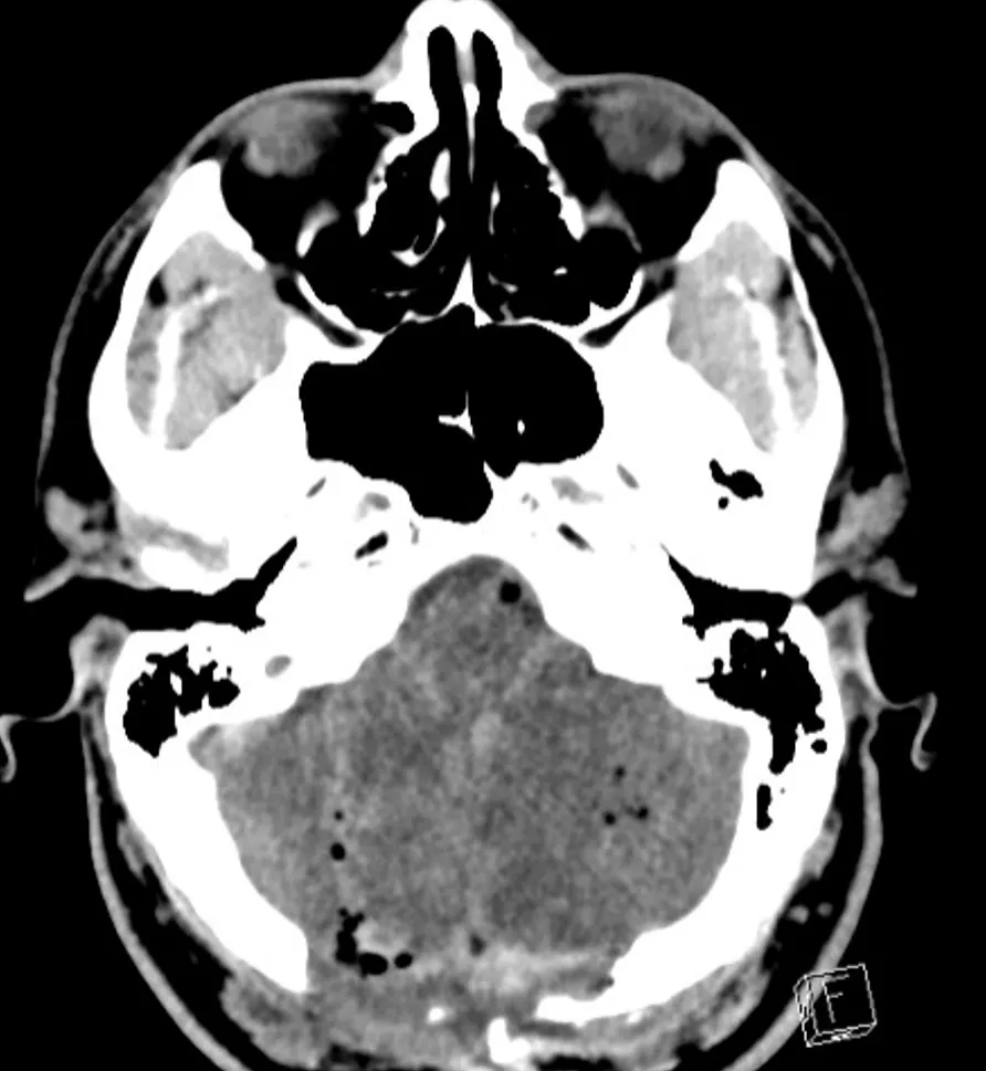 CT post suboccipital craniotomy